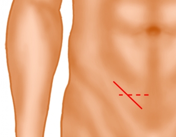 Inguinal skin incision