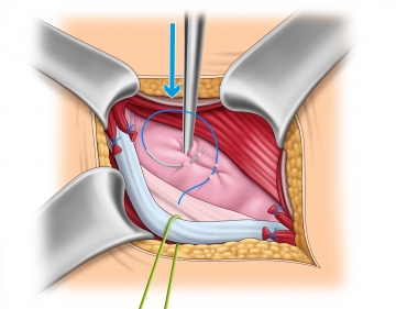 Hernia sac management in direct hernia