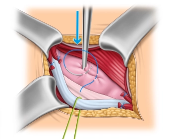 Management of the hernial sac – Direct hernia