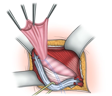 Management of the hernial sac– Indirect hernia