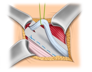 Mesh fixation on the inguinal ligament