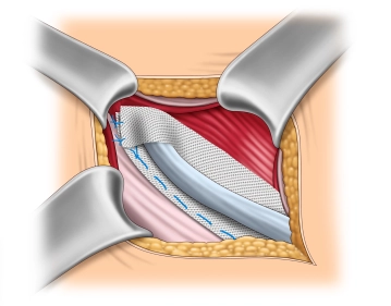 Reconstruction of the internal inguinal ring