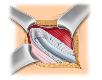 Mesh fixation on the internal oblique muscle