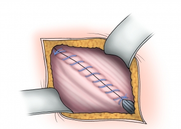 Closure of the external oblique aponeurosis