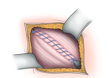 Closure of the external aponeurosis
