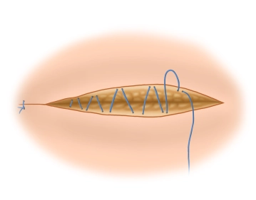 Ending the operation