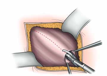 Division of the external oblique aponeurosis