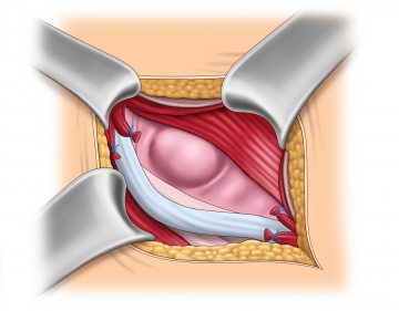 Preparation and identification of the hernia sac