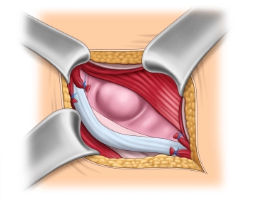 Dissection and identification of the hernia sac