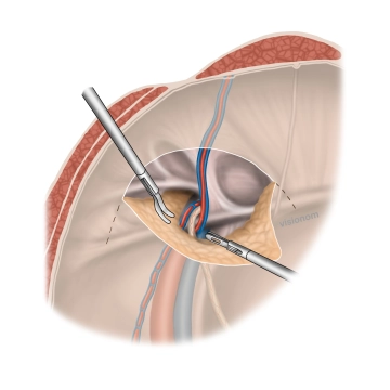 Exposure and repositioning of the hernia sac, mesh bed preparation