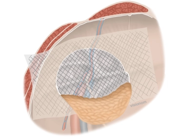 Insertion of the mesh