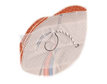 Closure of the peritoneal incision