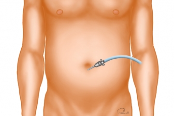 Accomplishing the pneumoperitoneum