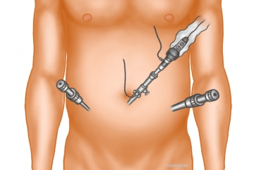 Trocar positions