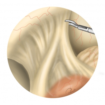 Reducing the contents of the hernia sac