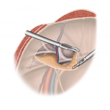 Incising and dissecting the peritoneum, exposing the anatomical landmarks