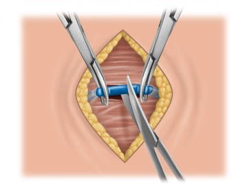 Subcutaneous dissection, midline division