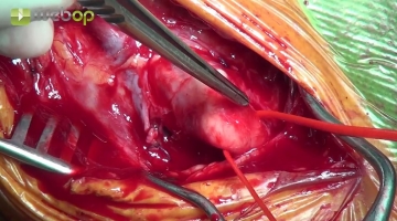 Dissecting the common carotid artery