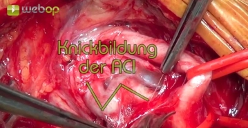 Dissecting the internal and external carotid arteries