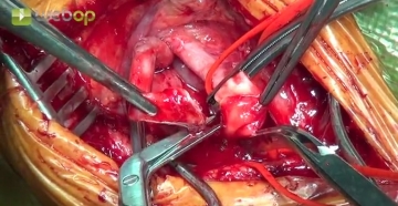Clamping the carotid arteries and transecting the ICA
