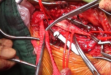 Right inguinal end-to-side anastomosis