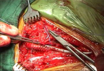 Closing the inguinal incisions