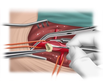 TEA of the right femoral artery