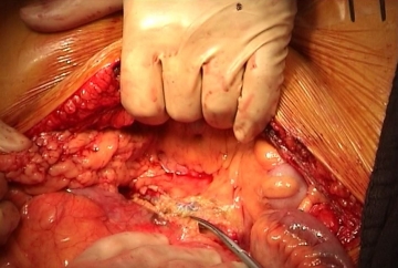 Opening the retroperitoneum and exposing the aorta