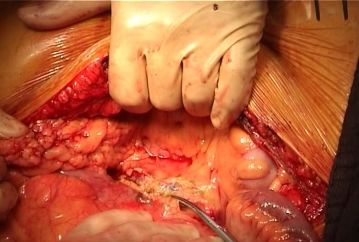 Opening the retroperitoneum and exposing the aorta