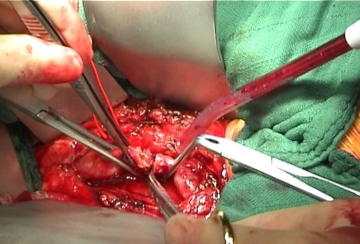 Cross-clamping the terminal aorta