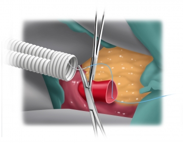 End-to-end central anastomosis