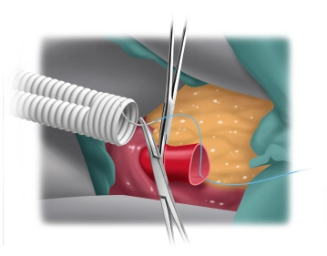 End-to-end central anastomosis