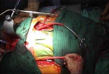 Pulling through both graft limbs retroperitoneally to the groins