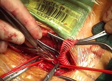 Left inguinal end-to-side anastomosis