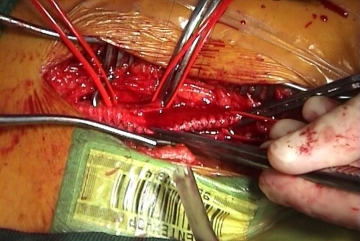 Flushing and releasing the left limb of the graft