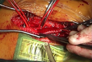 Flushing and releasing the left limb of the graft
