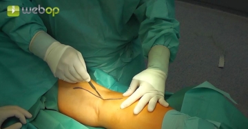 Accessing the right popliteal artery from posterior
