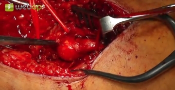 Exposing the popliteal artery/aneurysm