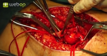 Resecting the aneurysm