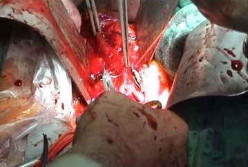 Suturing the aortotomy