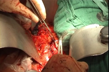 Closing the retroperitoneum