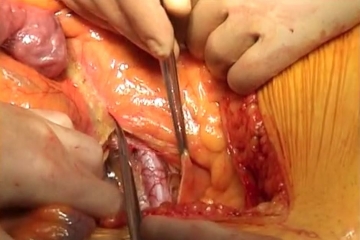  Opening the retroperitoneum and exposing the left renal vein