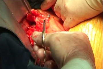 Dissecting the infrarenal aorta 