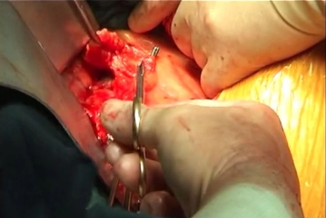 Dissecting the infrarenal aorta 