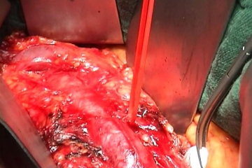 Dissecting and looping the inferior mesenteric artery