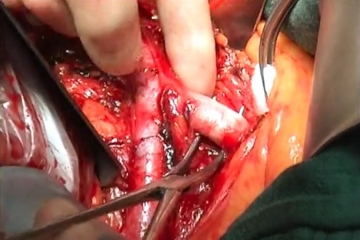 Dissecting and looping the left common iliac artery