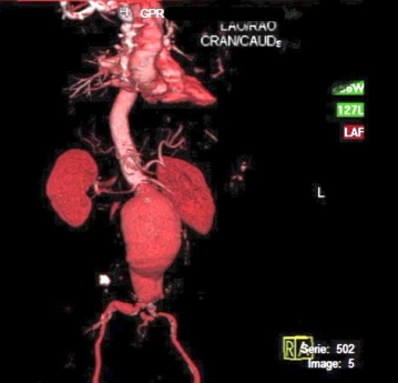 Dynamic three-dimensional spiral CT image of an infrarenal abdominal aortic aneurysm (AAA)