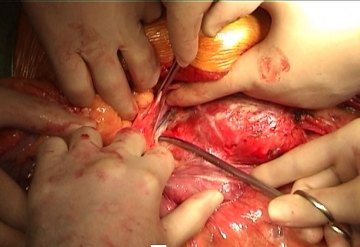Dissecting the pelvic arteries and the aneurysm neck