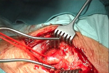 Dissecting the left common carotid artery 