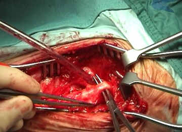 Dissecting the carotid bifurcation, mobilizing the hypoglossal nerve